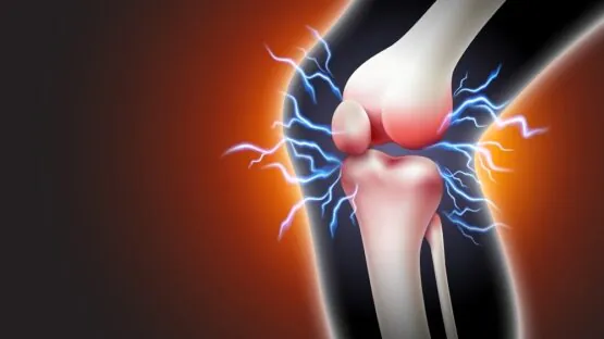 Knee arthritis